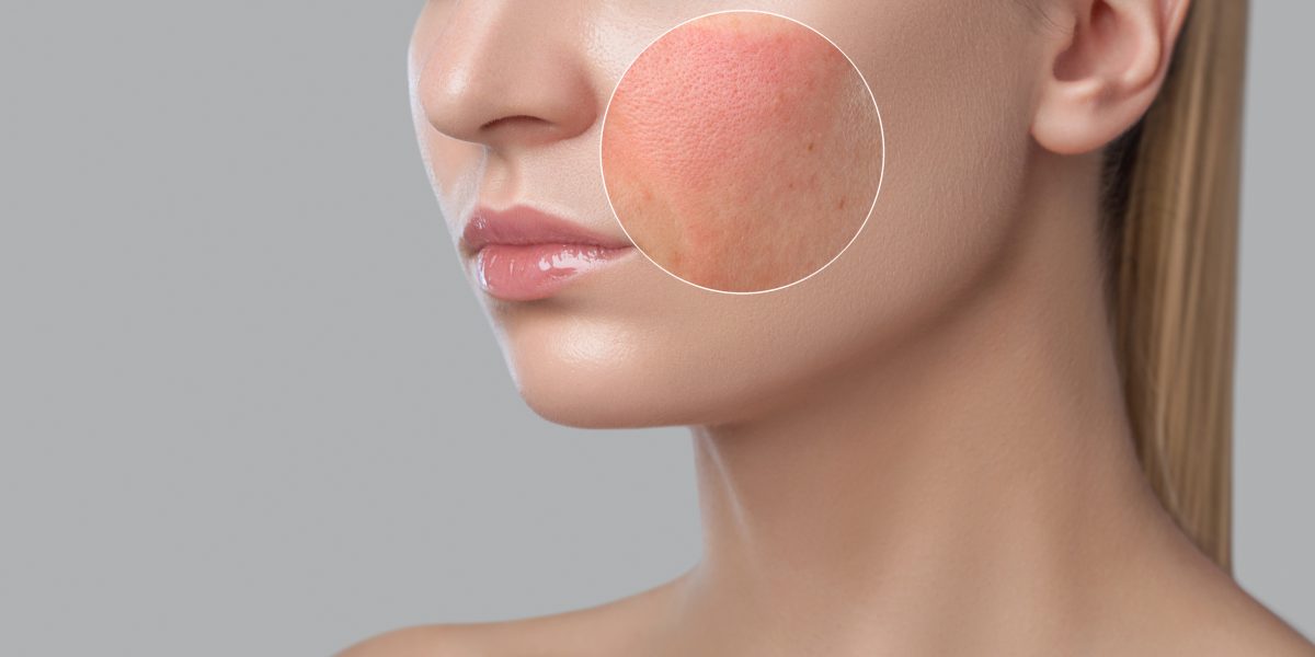 a-young-girl-with-a-problem-skin-photo-before-and-after-treatment-for-acne-and-demodecosis-skin-treatment-spa-treatments-cosmetology-and-professional-skin-care