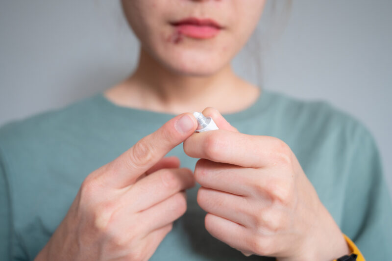 woman-holding-an-antiviral-cream-or-ointment-before-applying-cream-to-treat-herpes-labialis-on-her-lower-lip