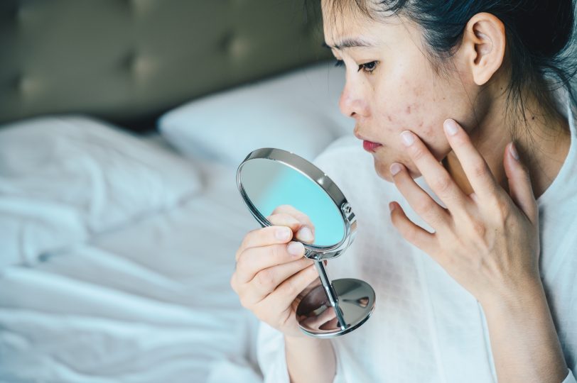 close-up-of-asian-woman-worry-about-her-face-when-she-saw-the-problem-of-acne-and-scar-by-the-mini-mirror